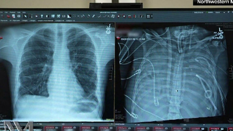 Medicii au scos plămânii unui bărbat și au pus în loc implanturi mamare
