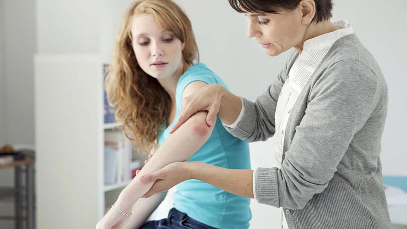 Boală cu tratament pe viață: Peste 2% din moldoveni suferă de psoriazis