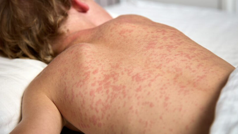Secretar de stat: Rujeola este mult mai contagioasă decât COVID-19