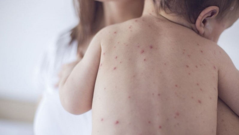 Ce spune Bolocan despre starea celor cinci copii infectați cu rujeolă