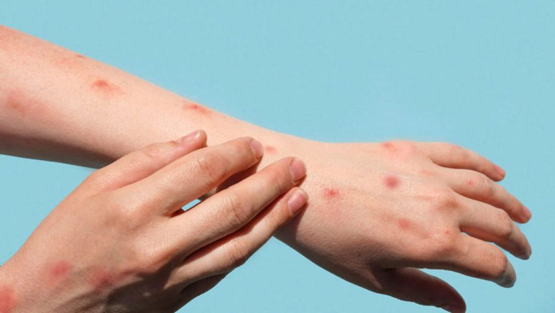 Cazuri de rujeolă, înregistrate la persoanele care se întorc din Bukovel