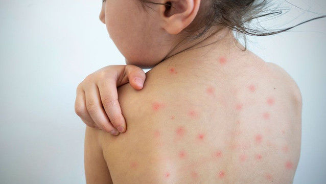 Trei cazuri noi de rujeolă la Chișinău: Medicii reiterează importanța vaccinării