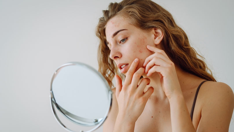 Acneea hormonală: Cauze, tratamente și sfaturi utile