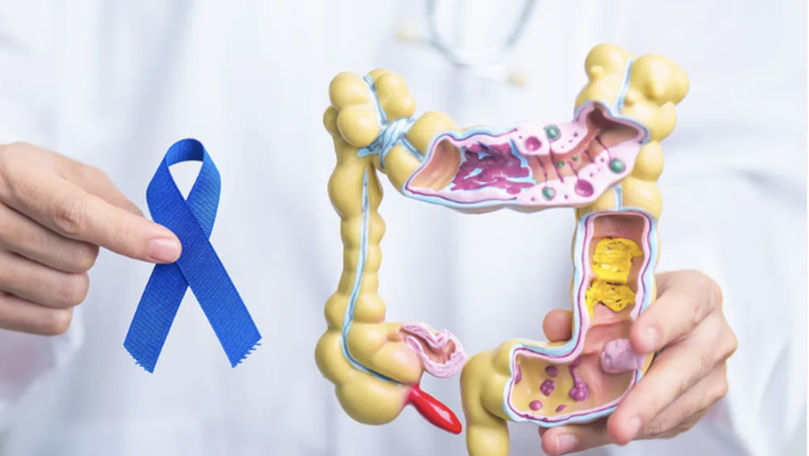Tot mai mulți tineri sunt diagnosticați cu cancer colorectal: Ce spun medicii