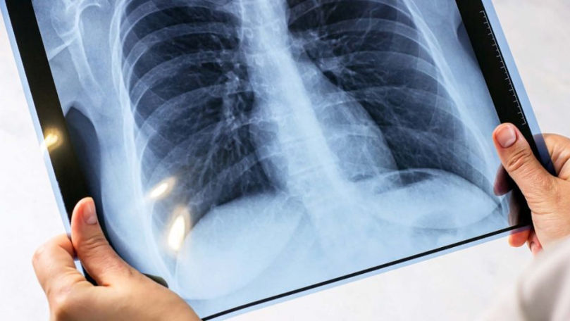 Autoritățile țintesc reducerea tuberculozei cu 80% până în 2030