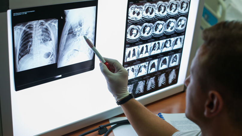 Radiografii gratuite la plămâni în mai multe localități din raionul Hâncești