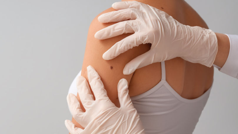 Medic: O aluniță care își schimbă forma sau culoarea poate ascunde un cancer de piele